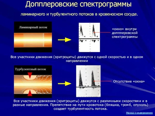 Допплеровские спектрограммы ламинарного и турбулентного потоков в кровеносном сосуде. «окно» внутри допплеровской