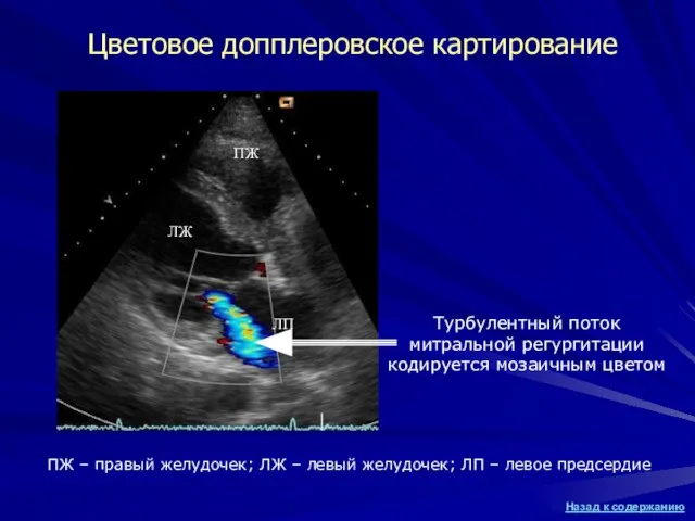 Цветовое допплеровское картирование Турбулентный поток митральной регургитации кодируется мозаичным цветом ПЖ ЛЖ