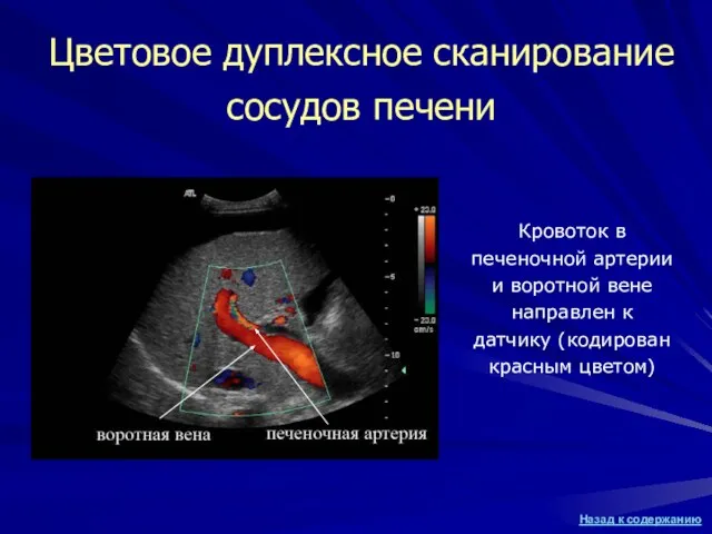 Цветовое дуплексное сканирование сосудов печени Кровоток в печеночной артерии и воротной вене