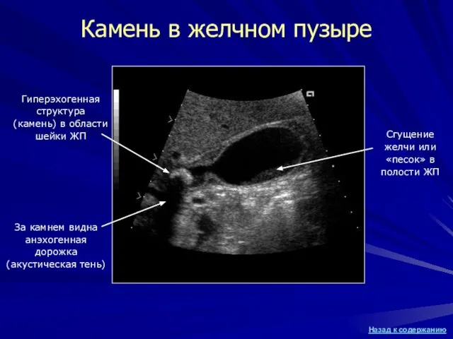 Камень в желчном пузыре Гиперэхогенная структура (камень) в области шейки ЖП За