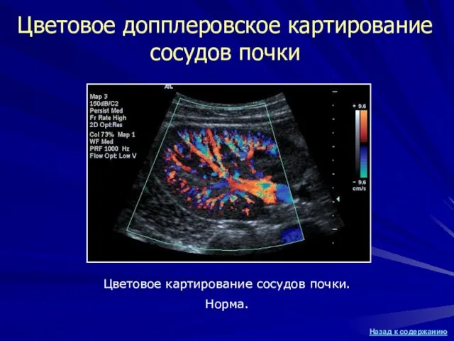 Цветовое допплеровское картирование сосудов почки Цветовое картирование сосудов почки. Норма.