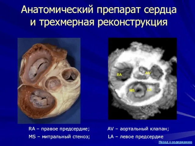 Анатомический препарат сердца и трехмерная реконструкция RA – правое предсердие; AV –