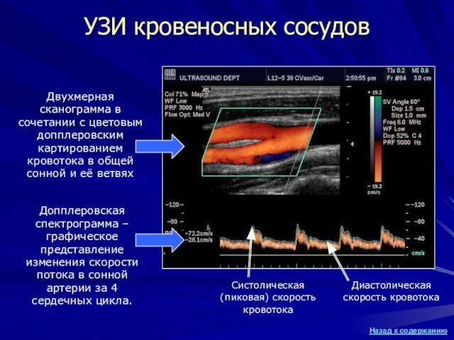 УЗИ кровеносных сосудов Двухмерная сканограмма в сочетании с цветовым допплеровским картированием кровотока