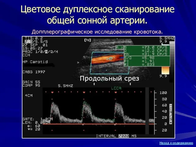 Цветовое дуплексное сканирование общей сонной артерии. Допплерографическое исследование кровотока. Продольный срез