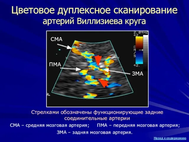 Цветовое дуплексное сканирование артерий Виллизиева круга Стрелками обозначены функционирующие задние соединительные артерии