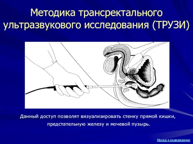 Методика трансректального ультразвукового исследования (ТРУЗИ) Данный доступ позволят визуализировать стенку прямой кишки,