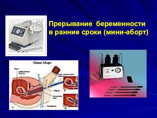 Прерывание беременности в ранние сроки (мини-аборт)