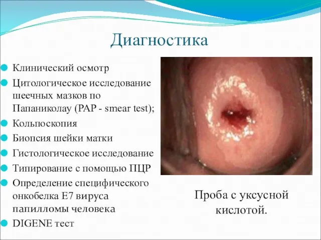 Диагностика Клинический осмотр Цитологическое исследование шеечных мазков по Папаниколау (PAP - smear
