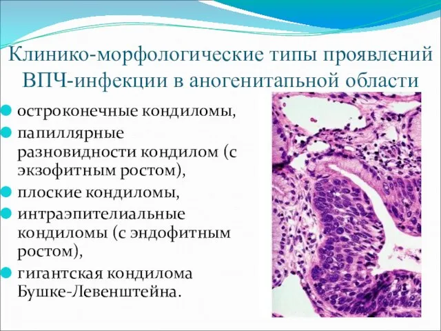 Клинико-морфологические типы проявлений ВПЧ-инфекции в аногенитапьной области остроконечные кондиломы, папиллярные разновидности кондилом