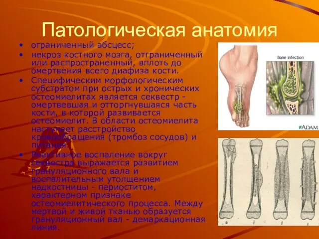 Патологическая анатомия ограниченный абсцесс; некроз костного мозга, отграниченный или распространенный, вплоть до