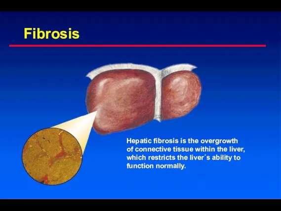 Fibrosis Hepatic fibrosis is the overgrowth of connective tissue within the liver,