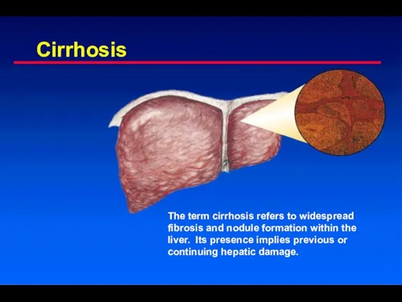 Cirrhosis The term cirrhosis refers to widespread fibrosis and nodule formation within