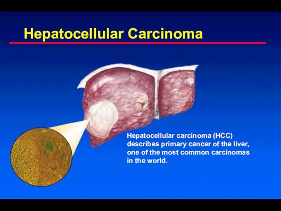 Hepatocellular Carcinoma Hepatocellular carcinoma (HCC) describes primary cancer of the liver, one