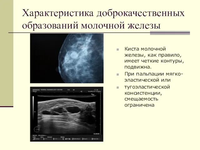 Характеристика доброкачественных образований молочной железы Киста молочной железы, как правило, имеет четкие