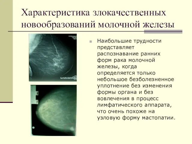 Характеристика злокачественных новообразований молочной железы Наибольшие трудности представляет распознавание ранних форм рака