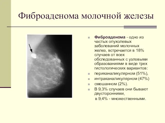 Фиброаденома молочной железы Фиброаденома - одно из частых опухолевых заболеваний молочных желез,