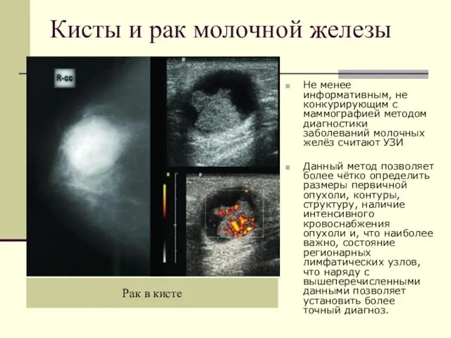 Рак в кисте Не менее информативным, не конкурирующим с маммографией методом диагностики