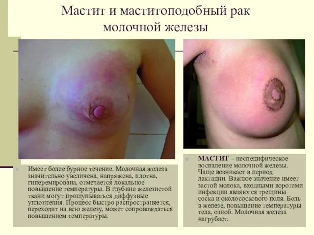 Мастит и маститоподобный рак молочной железы МАСТИТ – неспецифическое воспаление молочной железы.