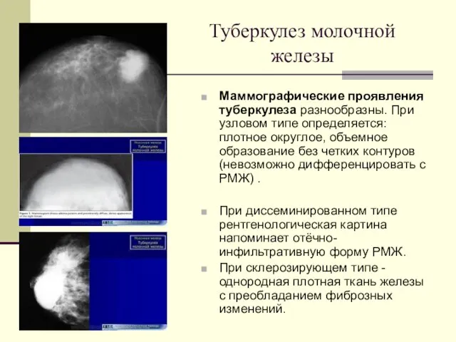 Туберкулез молочной железы Маммографические проявления туберкулеза разнообразны. При узловом типе определяется: плотное