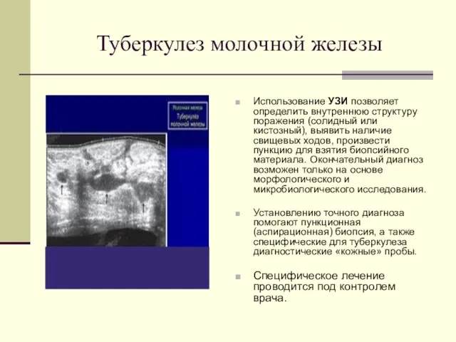 Туберкулез молочной железы Использование УЗИ позволяет определить внутреннюю структуру поражения (солидный или