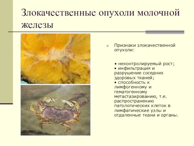 Злокачественные опухоли молочной железы Признаки злокачественной опухоли: • неконтролируемый рост; • инфильтрация