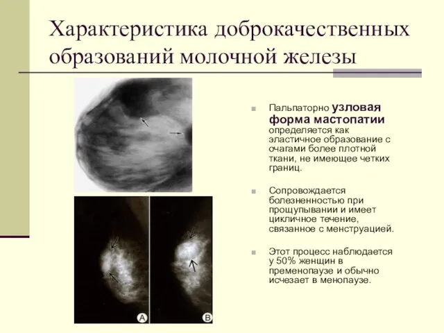 Характеристика доброкачественных образований молочной железы Пальпаторно узловая форма мастопатии определяется как эластичное