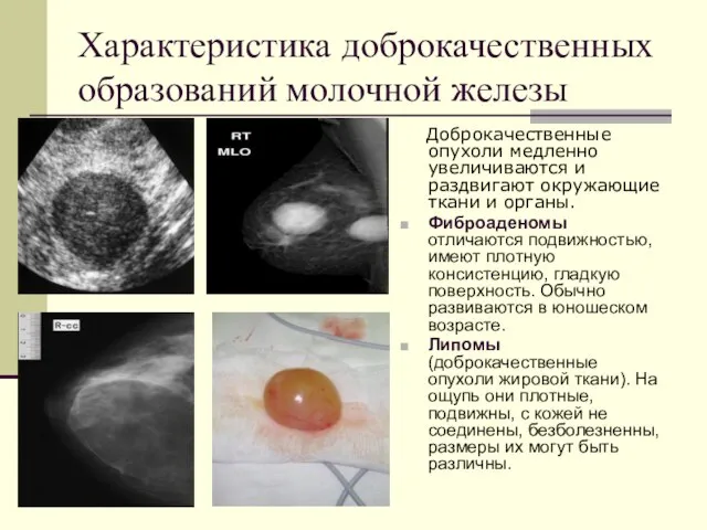 Характеристика доброкачественных образований молочной железы Доброкачественные опухоли медленно увеличиваются и раздвигают окружающие