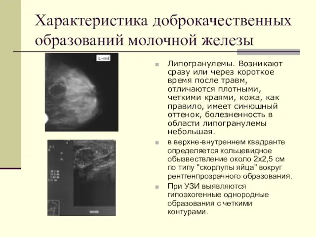 Характеристика доброкачественных образований молочной железы Липогранулемы. Возникают сразу или через короткое время