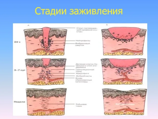 Стадии заживления