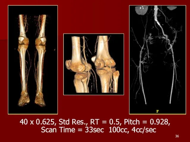 40 x 0.625, Std Res., RT = 0.5, Pitch = 0.928, Scan