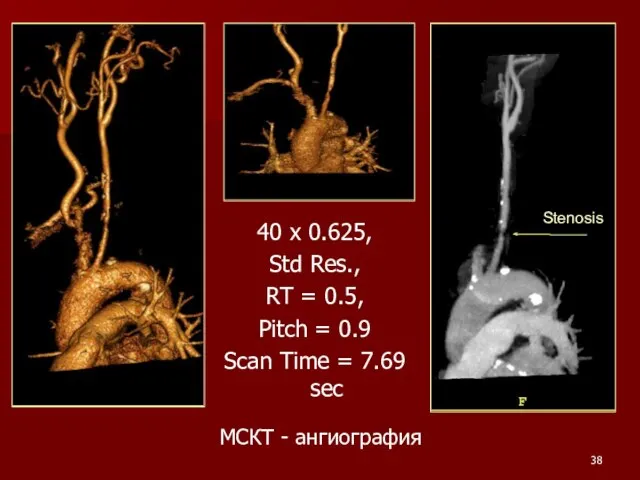 Stenosis 40 x 0.625, Std Res., RT = 0.5, Pitch = 0.9