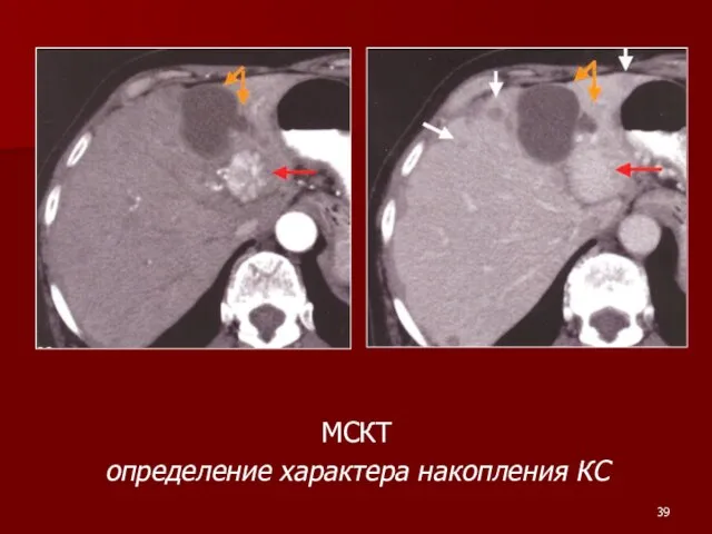 MСКТ определение характера накопления КС