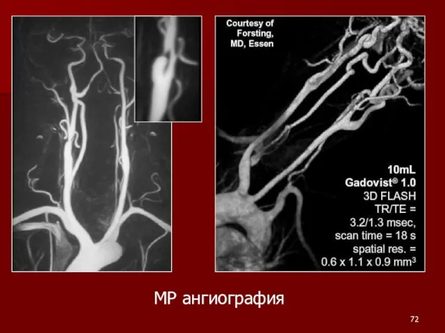 МР ангиография