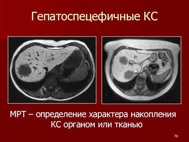 МРТ – определение характера накопления КС органом или тканью Гепатоспецефичные КС