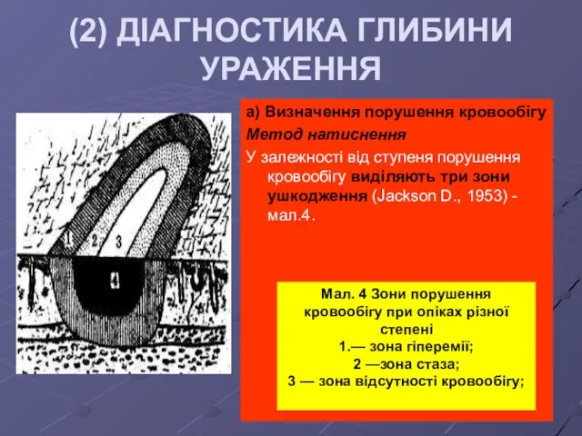 (2) ДІАГНОСТИКА ГЛИБИНИ УРАЖЕННЯ а) Визначення порушення кровообігу Метод натиснення У залежності