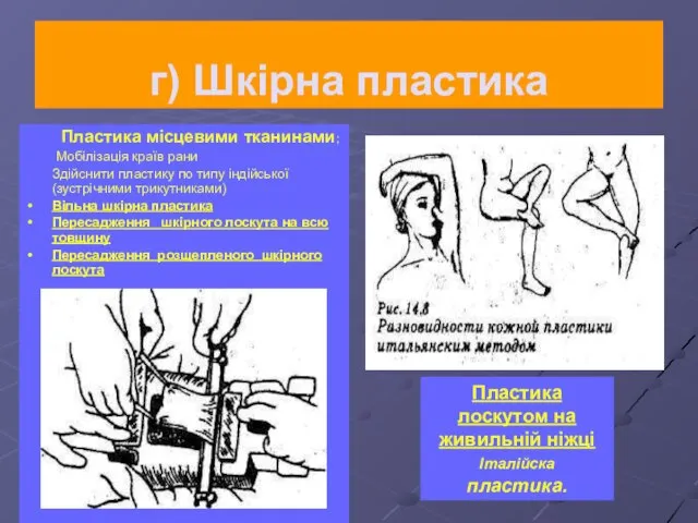 г) Шкірна пластика Пластика місцевими тканинами; Мобілізація країв рани Здійснити пластику по