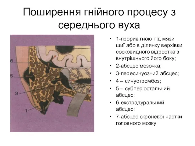 Поширення гнійного процесу з середнього вуха 1-прорив гною під мязи шиї або