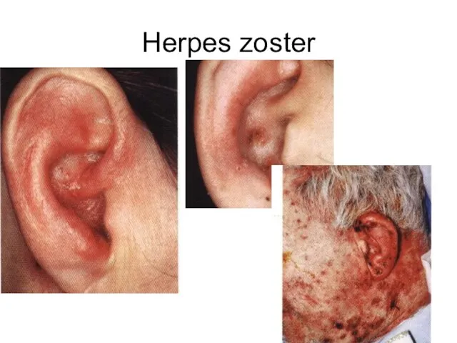 Herpes zoster