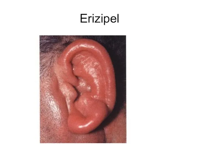 Erizipel