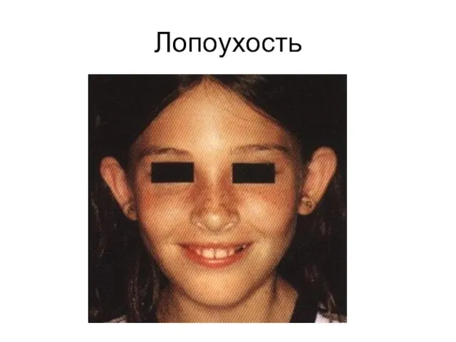 Лопоухость