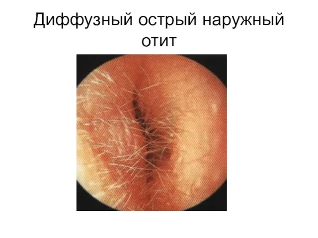 Диффузный острый наружный отит