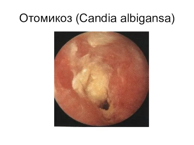 Отомикоз (Candia albigansa)