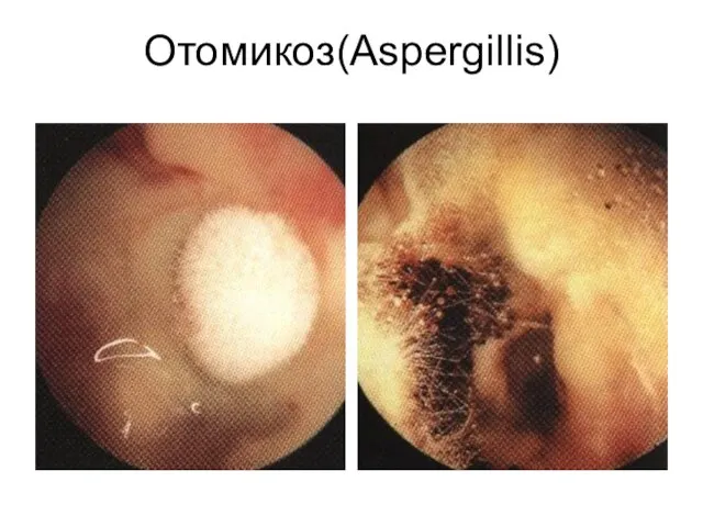 Отомикоз(Aspergillis)