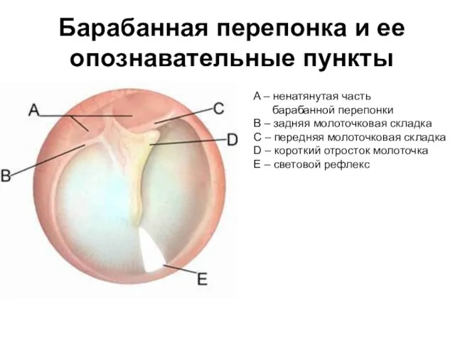 Барабанная перепонка и ее опознавательные пункты A – ненатянутая часть барабанной перепонки