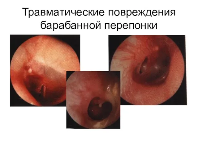 Травматические повреждения барабанной перепонки