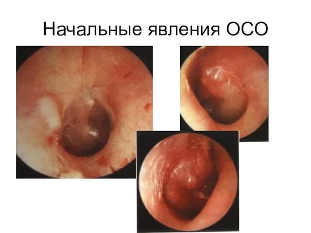 Начальные явления ОСО