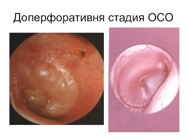 Доперфоративня стадия ОСО