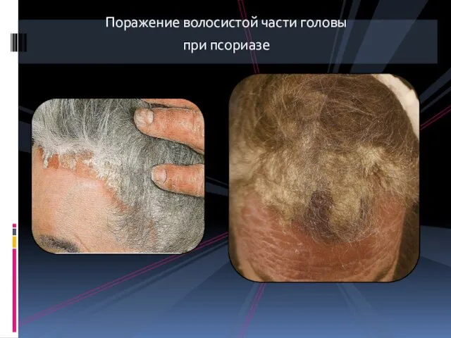 Поражение волосистой части головы при псориазе