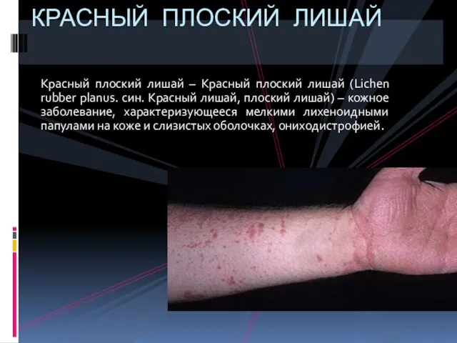 Красный плоский лишай – Красный плоский лишай (Lichen rubber planus. син. Красный