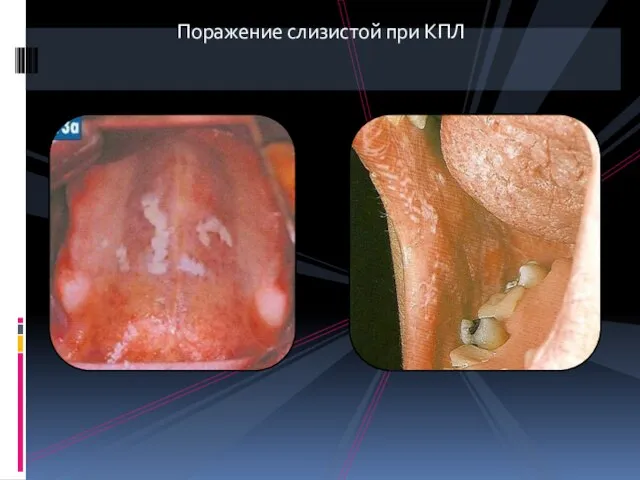 Поражение слизистой при КПЛ